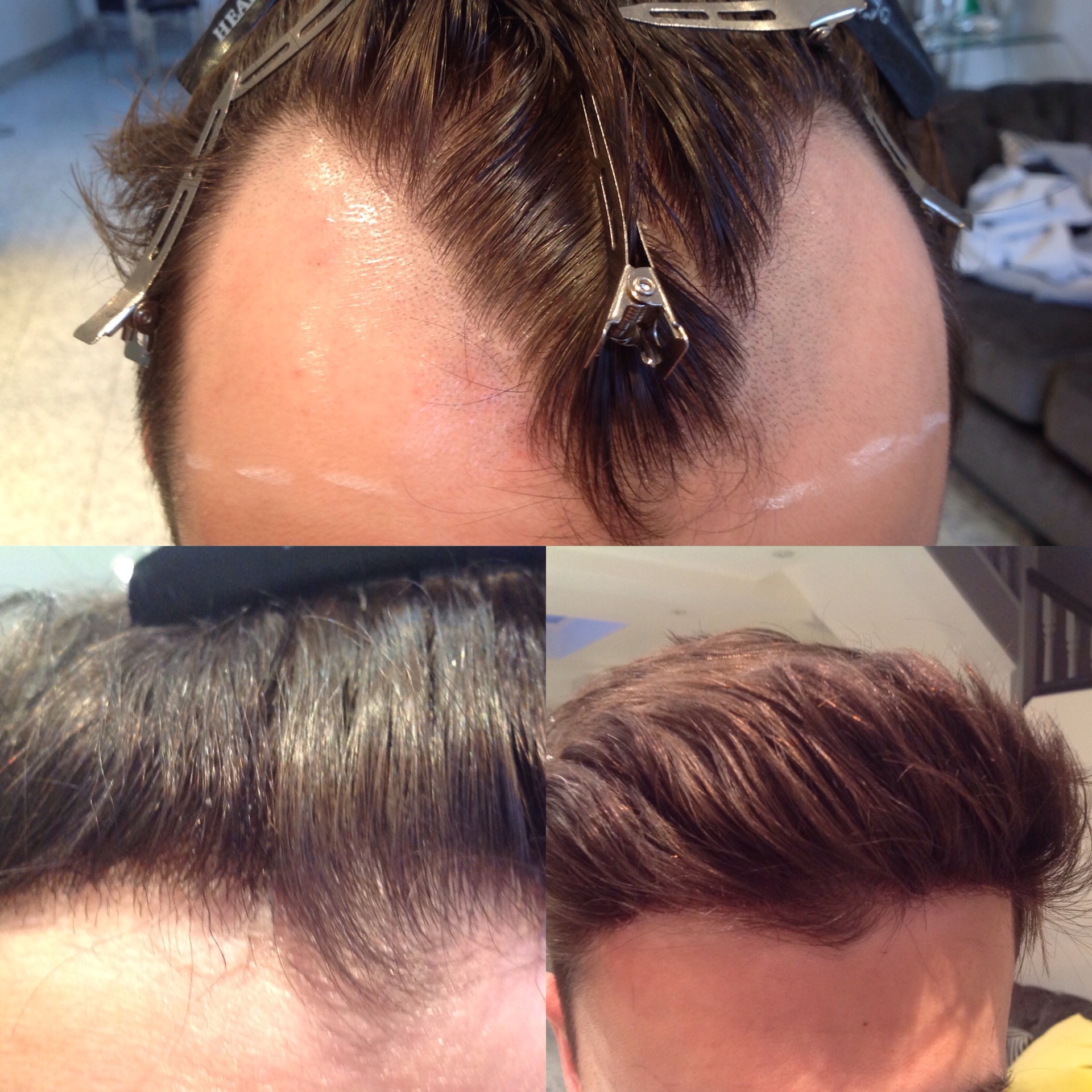 Hair replacement with brunette short hair on man
