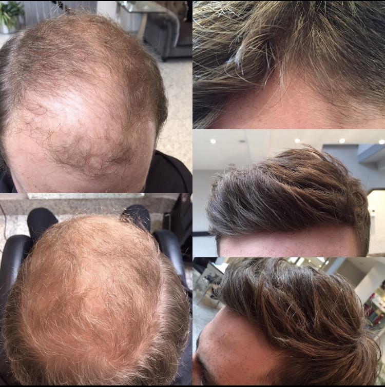 Hair replacement on man