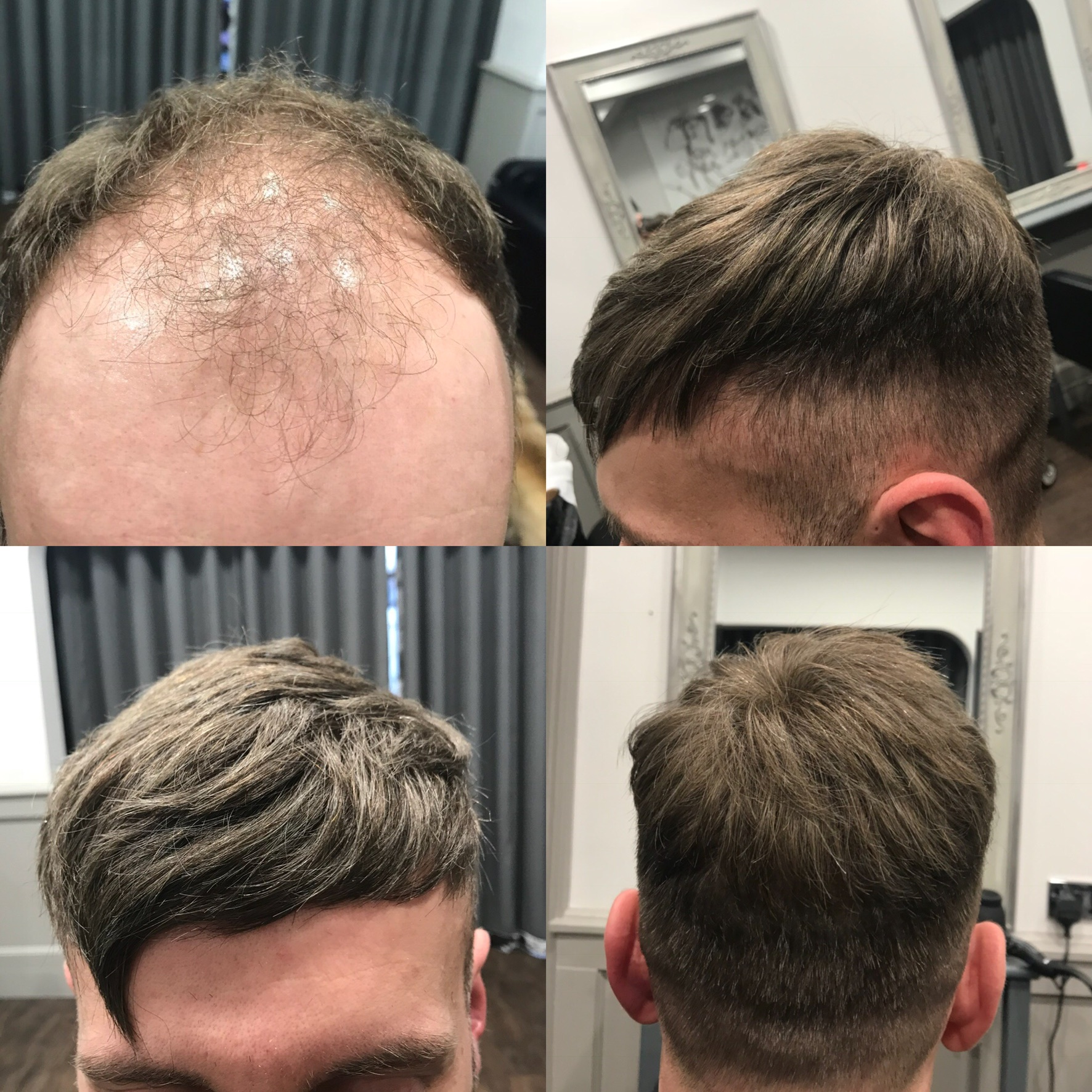 Hair replacement with brunette short hair on man
